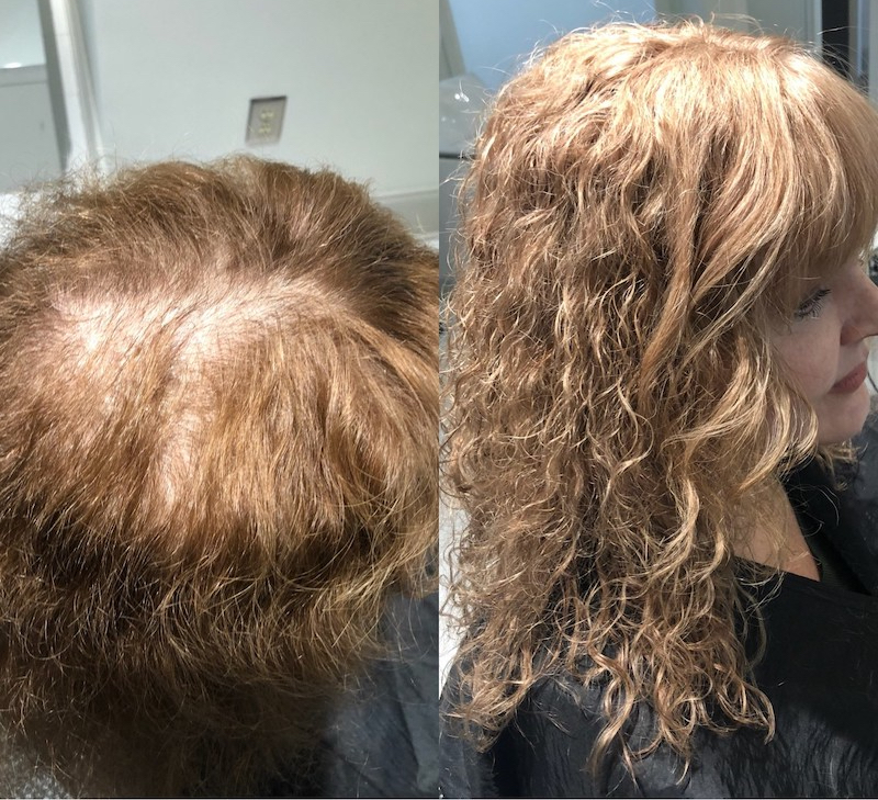 Before and After Evolve Hair Loss Solution
