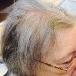Woman with thinning hair before receiving treatment