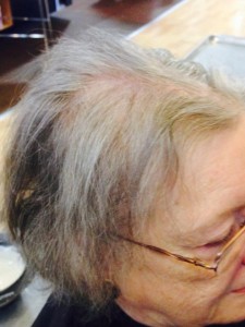 Woman with thinning hair before receiving treatment