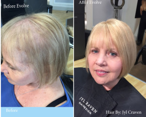 A before image of a woman with thinning hair, and an after image of the same woman with thicker hair