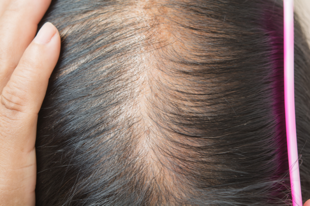 Close-up of a person’s scalp showing visible hair thinning along the part line, with a hand holding the hair aside and a pink comb visible on the right side.