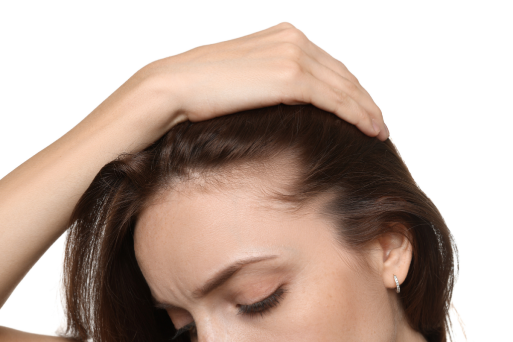 Woman holding back her hair to reveal thinning hair along the front hairline and temples against a light gray background.