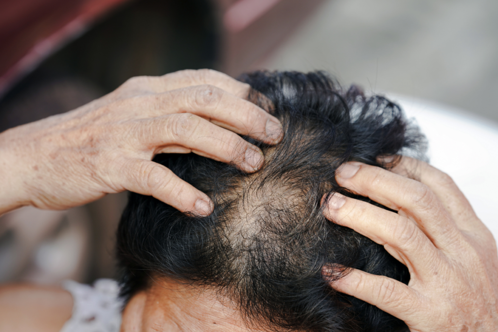 A person with thinning hair and visible scalp holds their head with both hands, showing signs of hair loss.