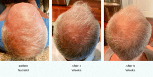 A man's hair before, after 7 weeks, and after 9 weeks of taking nutrafol and showing major improvement